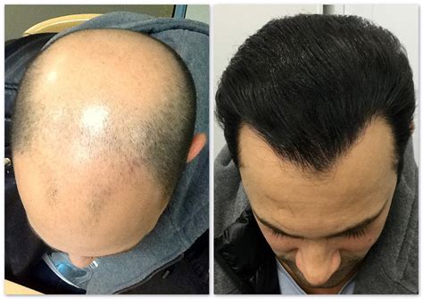 dubai best hair transplant clinic.